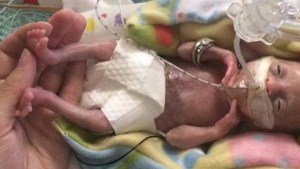Bebê prematura 21 semanas - família Stensrud
